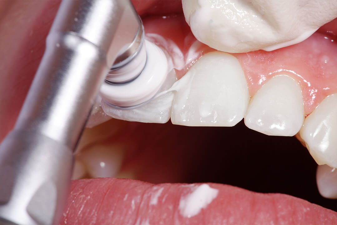 歯を清潔な状態に保つクリーニング
