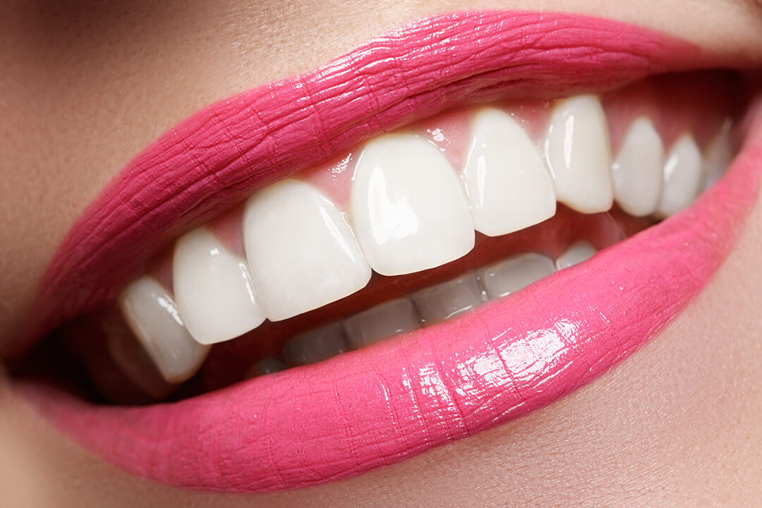 白くキレイな歯を実現するホワイトニング